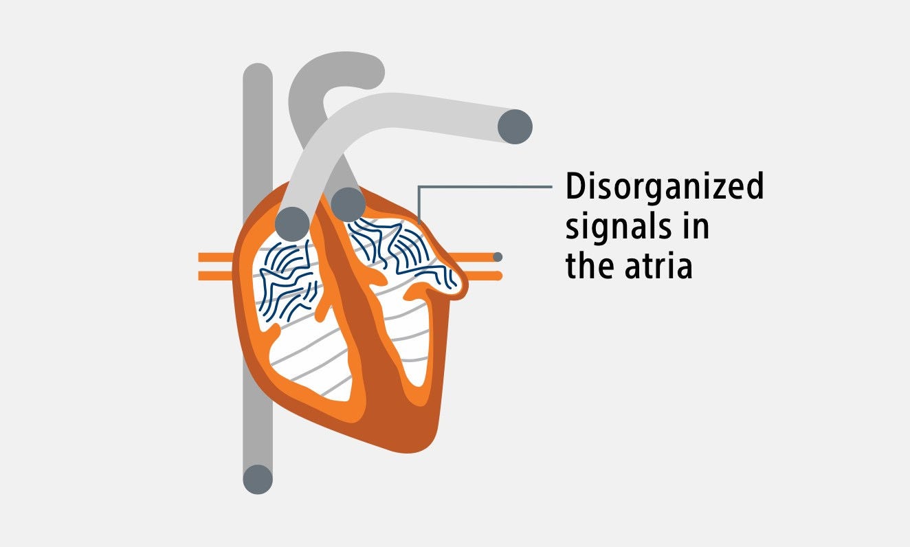 Heart image showing disorganized signals in the atria.