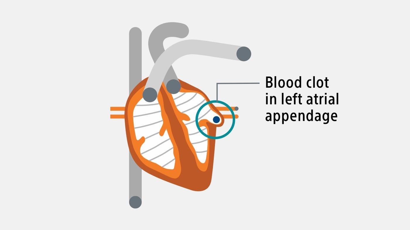 Heart image showing blood clot.
